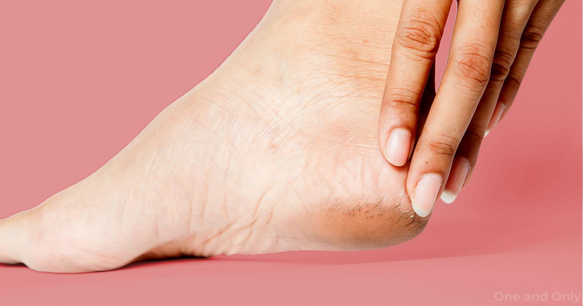 Cracked Heels – Causes and Prevention