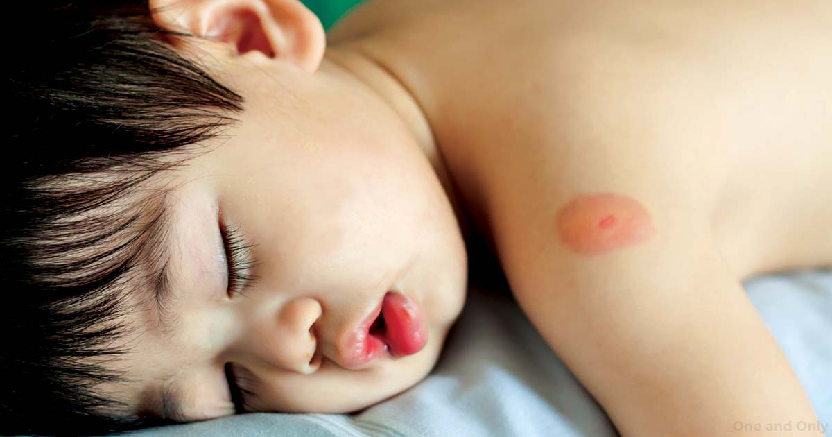 How to Protect Kids from Mosquito Bites? 