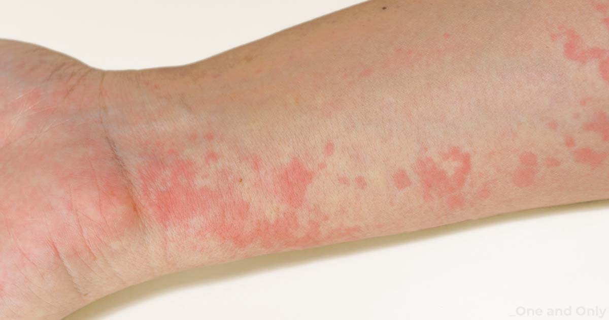Hives (Urticaria): Types, Causes, Symptoms, and Treatment