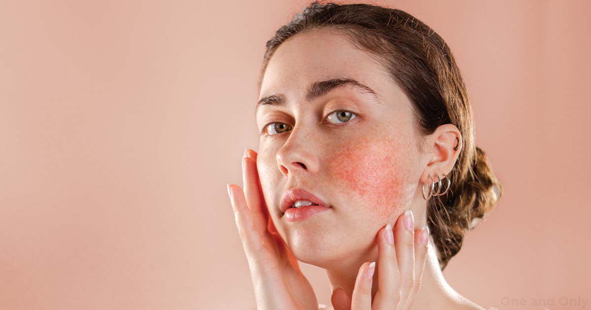 Rosacea: Causes, Types, Symptoms, and Prevention