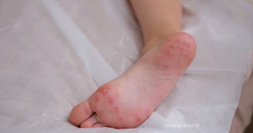 Hand, Foot, and Mouth Disease – Causes and Symptoms